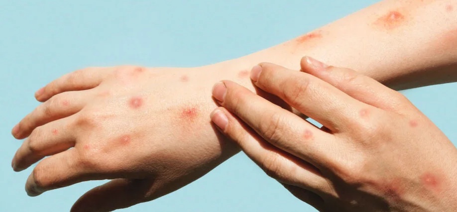 Mpox: casos aumentam no Rio de Janeiro